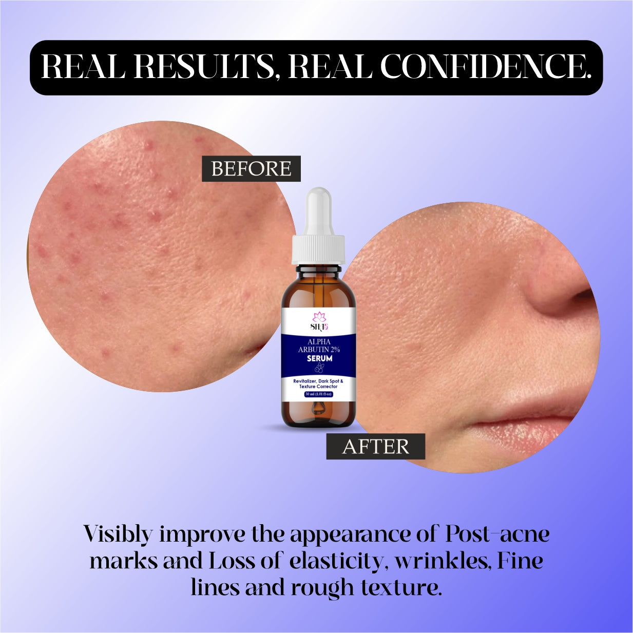 Alpha Arbutin Serum 2% + Hyaluronic Acid – Dark Spot Corrector for Face – Brightening & Hydrating Facial Serum – Reduces Hyperpigmentation, Uneven Skin Tone & Acne Scars – 30ml